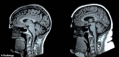 งานวิจัยใหม่เผยให้เห็นว่า toxoplasma - a งวล การรบกวนของระบบ GABA