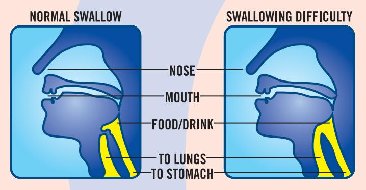 Dysphagia คืออะไร?