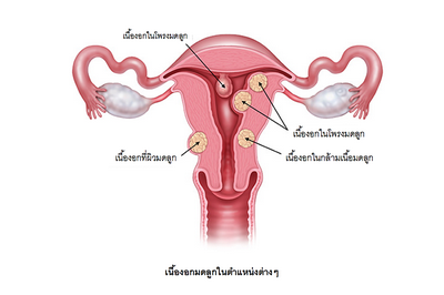 การกำจัดติ่งเนื้อมดลูก